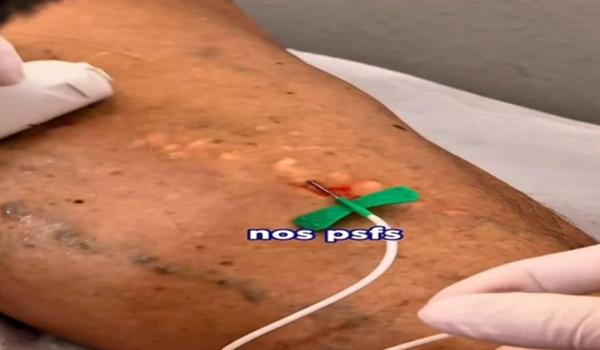 Imagens da SECRETARIA DE SAÚDE DE BARRA DO MENDES INICIOU A SEGUNDA ETAPA DO TRATAMENTO DE ESCLEROTERAPIA